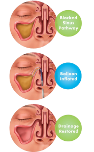 The Basics on Balloon Sinuplasty - Phoenix PHX