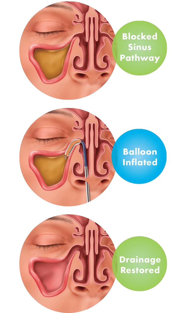 the-basics-on-balloon-sinuplasty-phoenix-phx